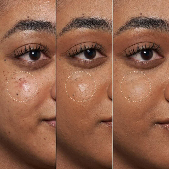 Gel Secativo Fenty Skin Blemish Defeat'r BHA